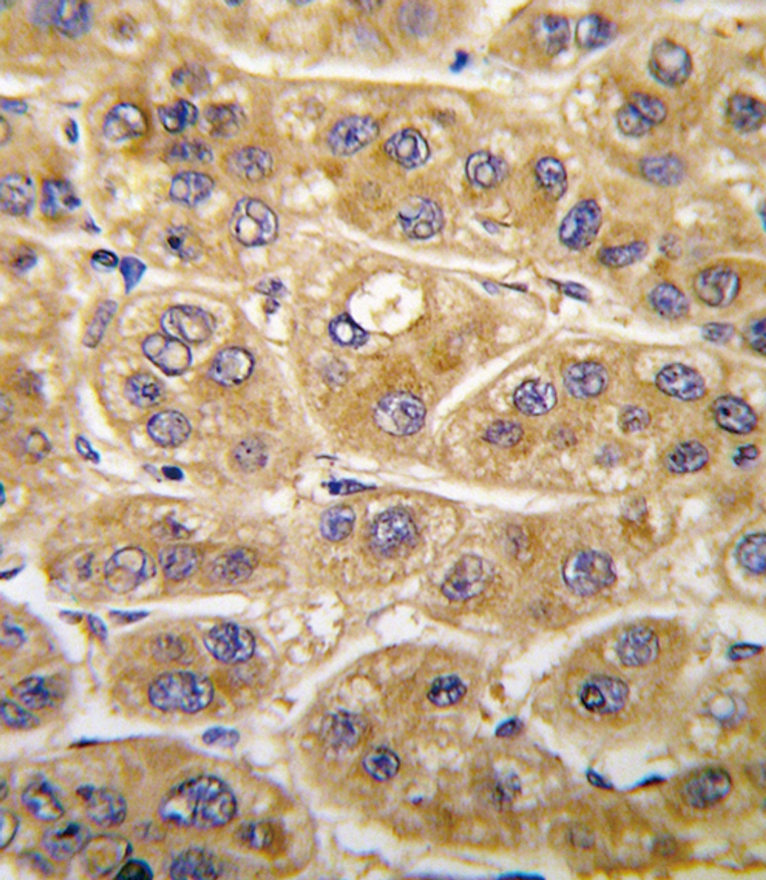 Formalin-fixed and paraffin-embedded human hepatocarcinoma tissue reacted with AGT antibody, which was peroxidase-conjugated to the secondary antibody, followed by DAB staining.