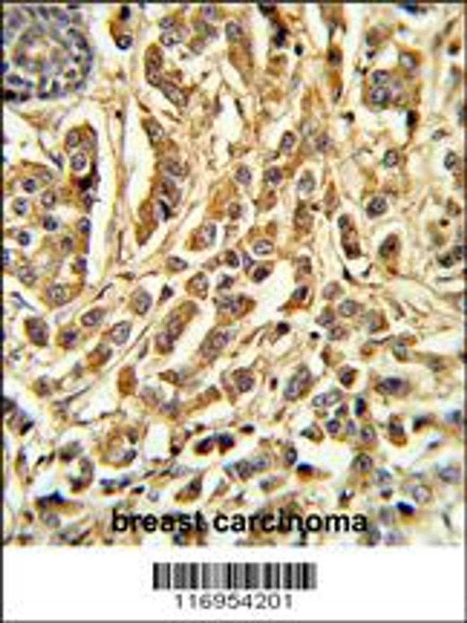 Formalin-fixed and paraffin-embedded human breast carcinoma reacted with CYP21A2 Antibody, which was peroxidase-conjugated to the secondary antibody, followed by DAB staining.