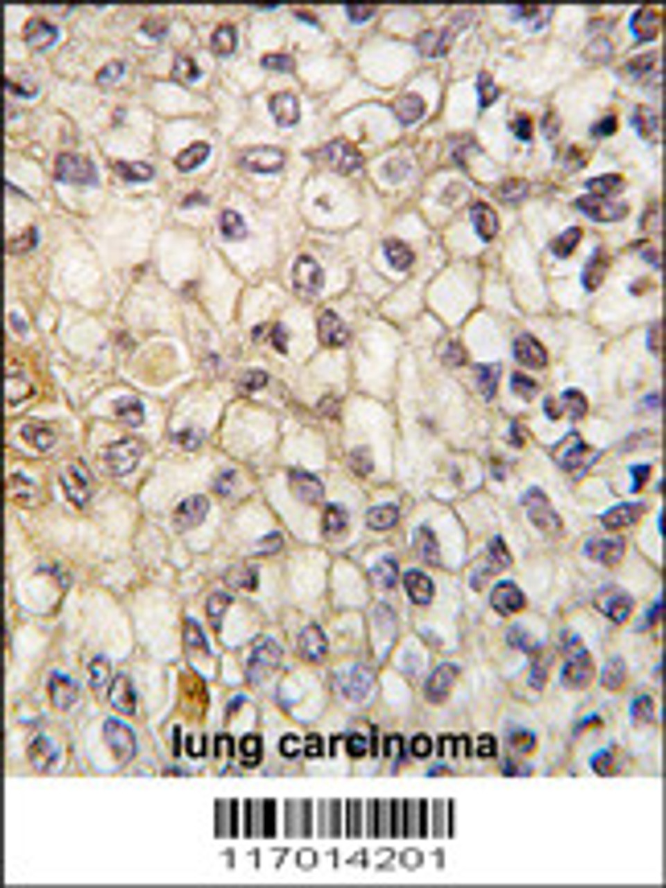 Formalin-fixed and paraffin-embedded human lung carcinoma tissue reacted with CYP2F1 antibody, which was peroxidase-conjugated to the secondary antibody, followed by DAB staining.