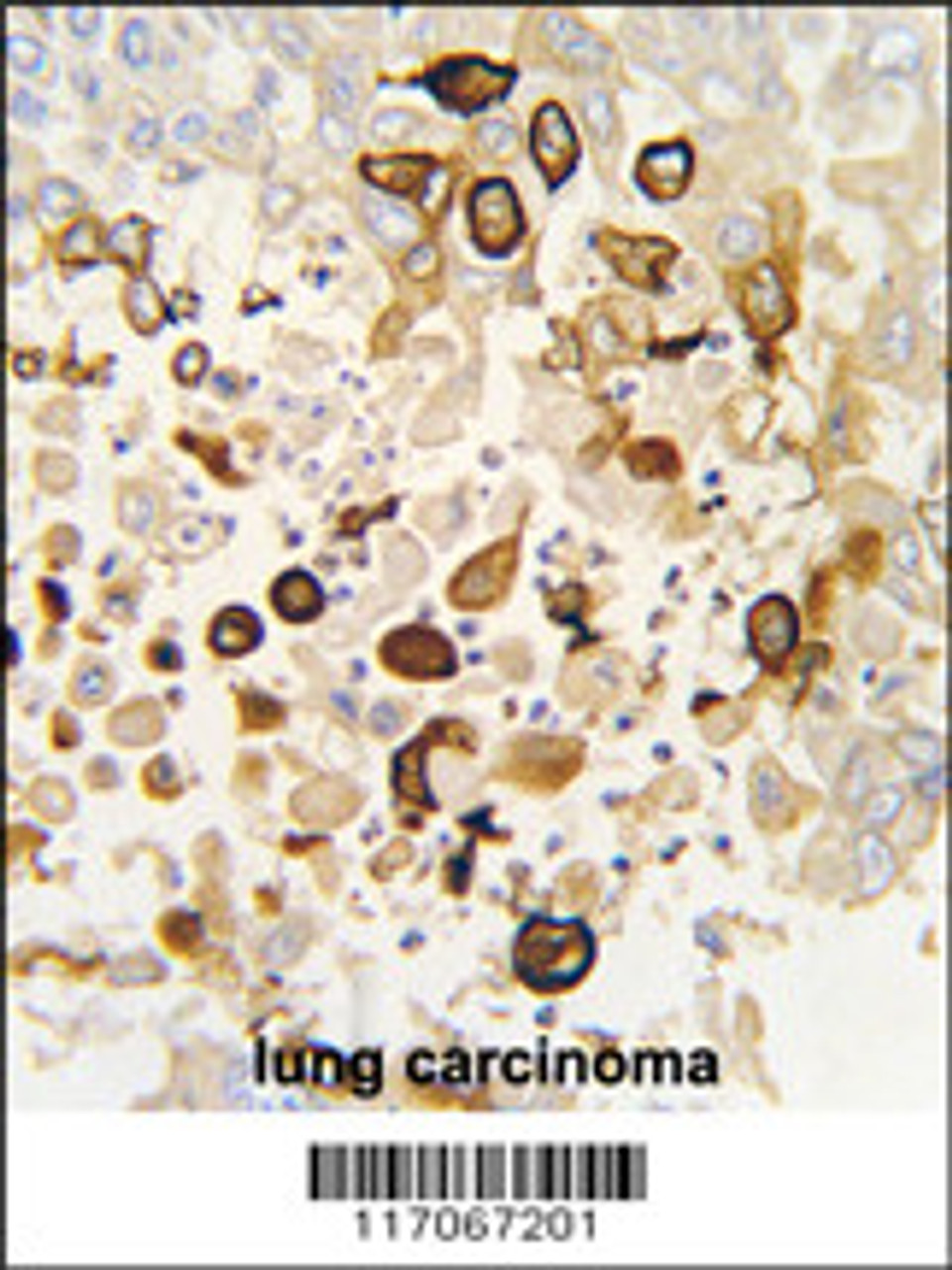 Formalin-fixed and paraffin-embedded human lung carcinoma tissue reacted with CYP4X1 antibody (N-term) , which was peroxidase-conjugated to the secondary antibody, followed by DAB staining.