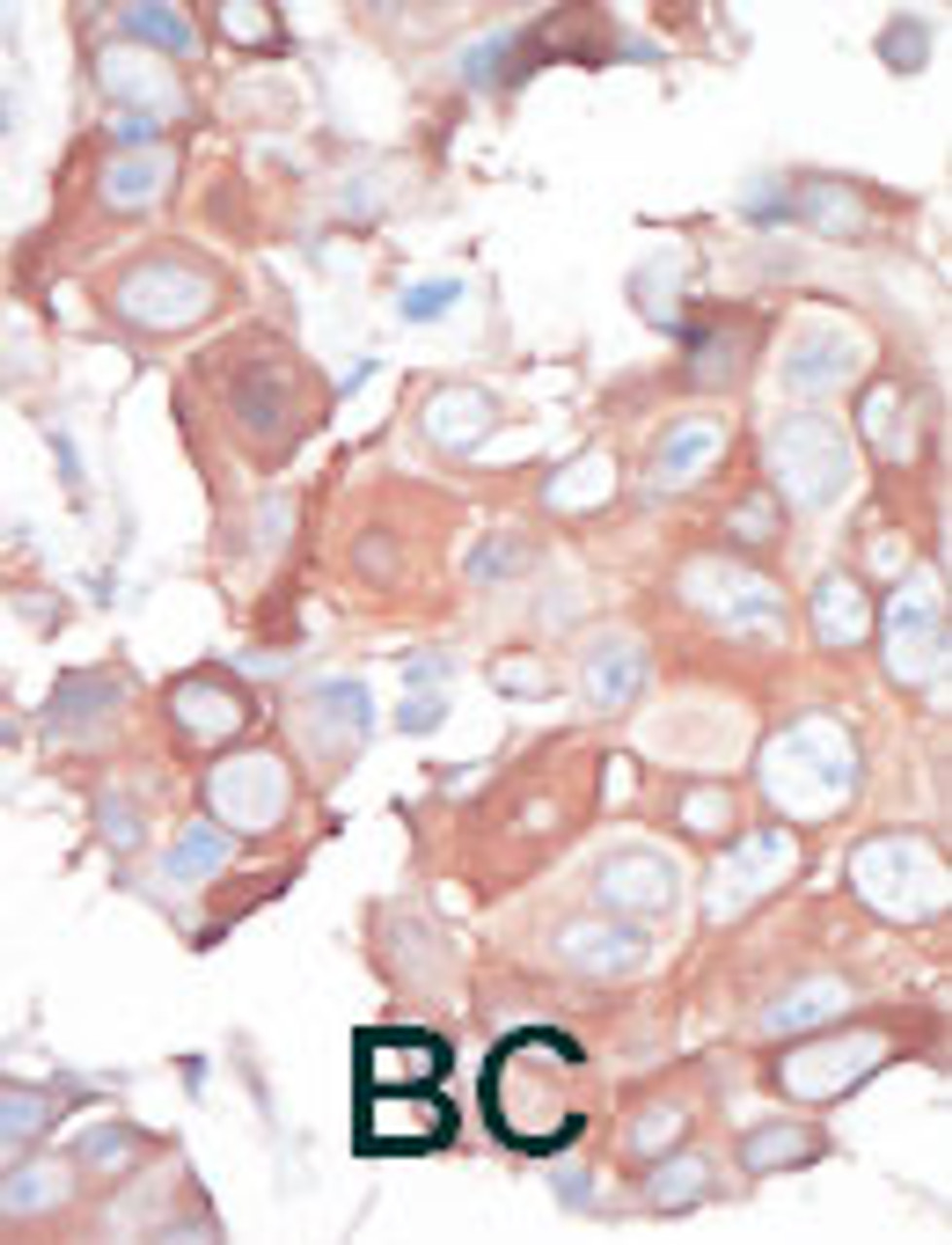 Formalin-fixed and paraffin-embedded human cancer tissue reacted with the primary antibody, which was peroxidase-conjugated to the secondary antibody, followed by AEC staining. BC = breast carcinoma; HC = hepatocarcinoma.