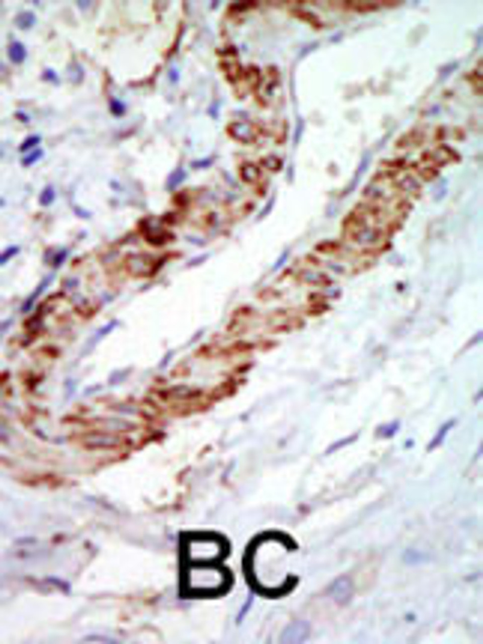 Formalin-fixed and paraffin-embedded human cancer tissue reacted with the primary antibody, which was peroxidase-conjugated to the secondary antibody, followed by DAB staining. BC = breast carcinoma; HC = hepatocarcinoma.