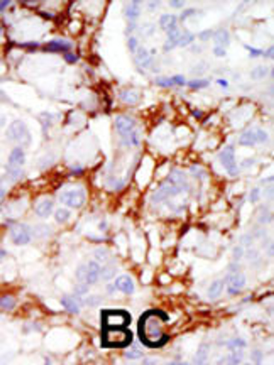 Formalin-fixed and paraffin-embedded human cancer tissue reacted with the primary antibody, which was peroxidase-conjugated to the secondary antibody, followed by AEC staining. BC = breast carcinoma; HC = hepatocarcinoma.