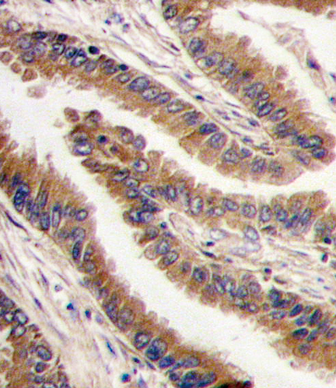 Formalin-fixed and paraffin-embedded human lung carcinoma tissue reacted with PRKX antibody, which was peroxidase-conjugated to the secondary antibody, followed by DAB staining.