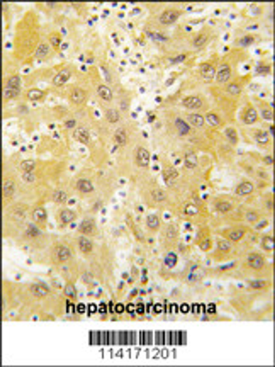 Formalin-fixed and paraffin-embedded human hepatocarcinoma tissue reacted with Tiparp antibody, which was peroxidase-conjugated to the secondary antibody, followed by DAB staining.