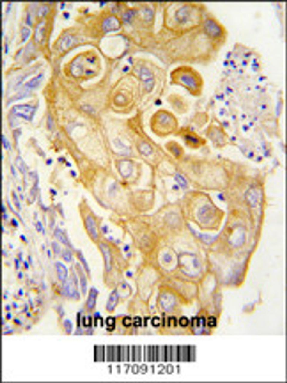 Formalin-fixed and paraffin-embedded human lung carcinoma tissue reacted with CYP8A1 antibody, which was peroxidase-conjugated to the secondary antibody, followed by DAB staining.