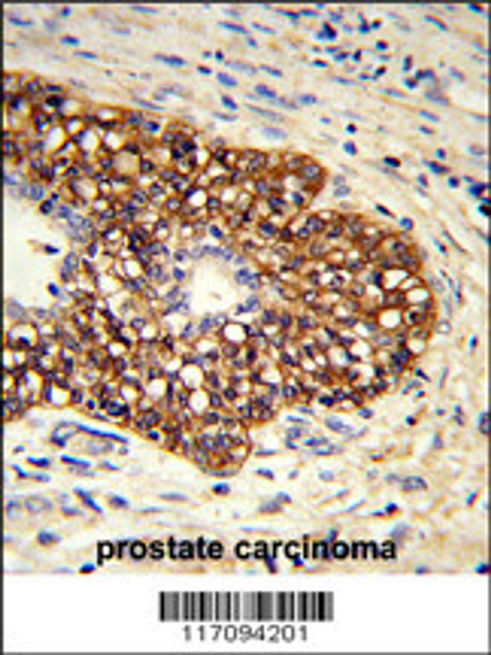 Formalin-fixed and paraffin-embedded human prostate carcinoma reacted with CYP8A1 Antibody, which was peroxidase-conjugated to the secondary antibody, followed by DAB staining.