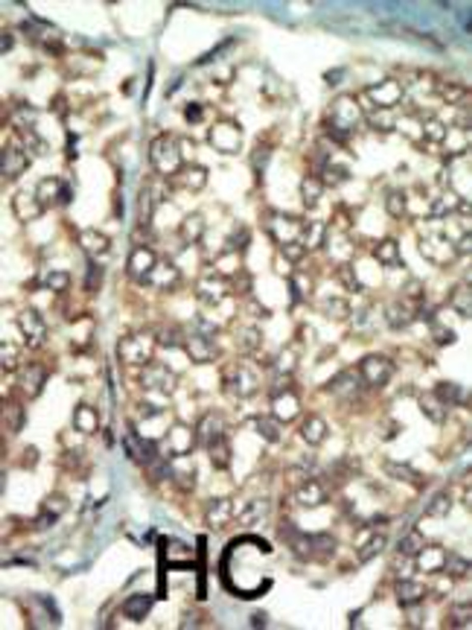 Formalin-fixed and paraffin-embedded human cancer tissue reacted with the primary antibody, which was peroxidase-conjugated to the secondary antibody, followed by AEC staining. BC = breast carcinoma; HC = hepatocarcinoma.