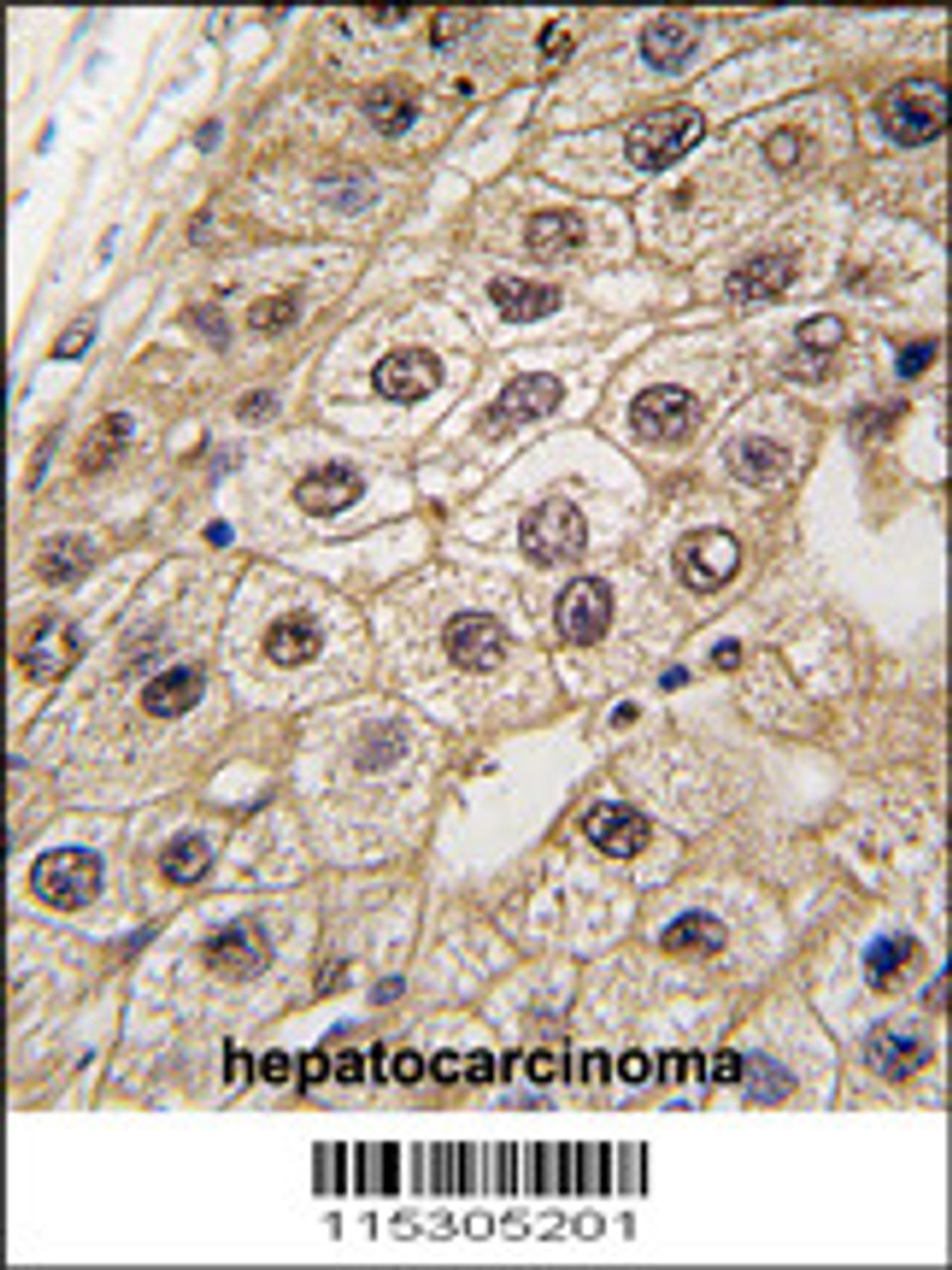 Formalin-fixed and paraffin-embedded human hepatocarcinoma tissue reacted with, which was peroxidase-conjugated to the secondary antibody, followed by DAB staining.