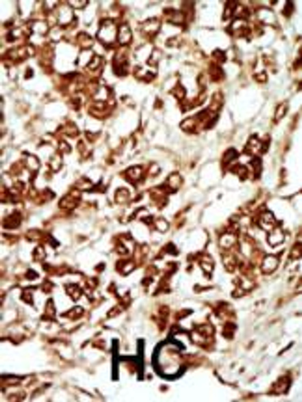 Formalin-fixed and paraffin-embedded human cancer tissue reacted with the primary antibody, which was peroxidase-conjugated to the secondary antibody, followed by AEC staining. BC = breast carcinoma; HC = hepatocarcinoma.