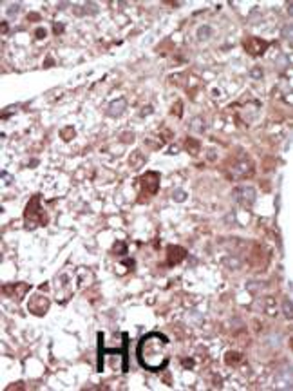 Formalin-fixed and paraffin-embedded human cancer tissue reacted with the primary antibody, which was peroxidase-conjugated to the secondary antibody, followed by DAB staining. BC = breast carcinoma; HC = hepatocarcinoma.