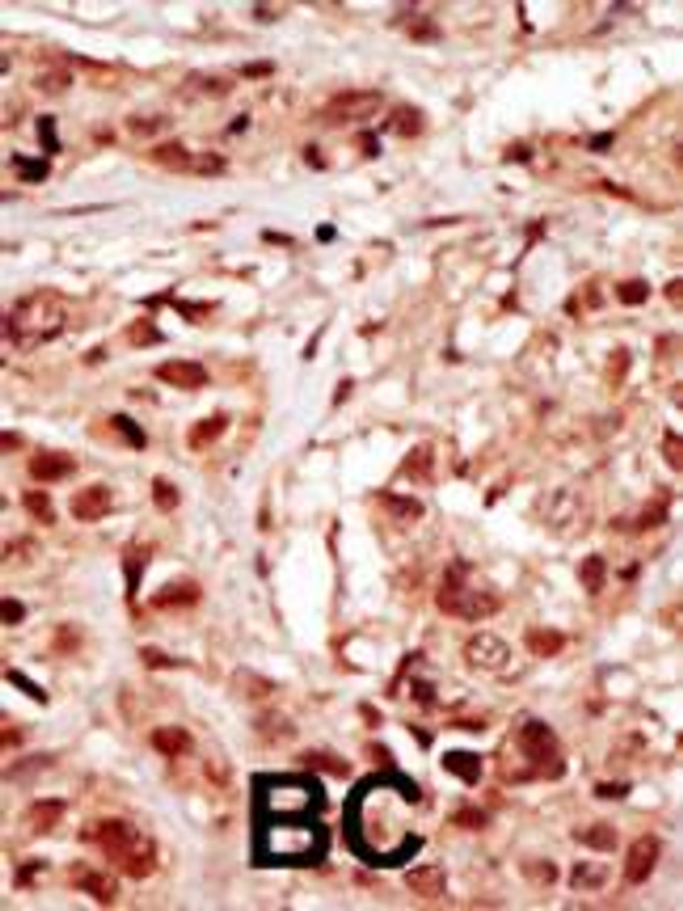 Formalin-fixed and paraffin-embedded human cancer tissue reacted with the primary antibody, which was peroxidase-conjugated to the secondary antibody, followed by DAB staining. BC = breast carcinoma; HC = hepatocarcinoma.