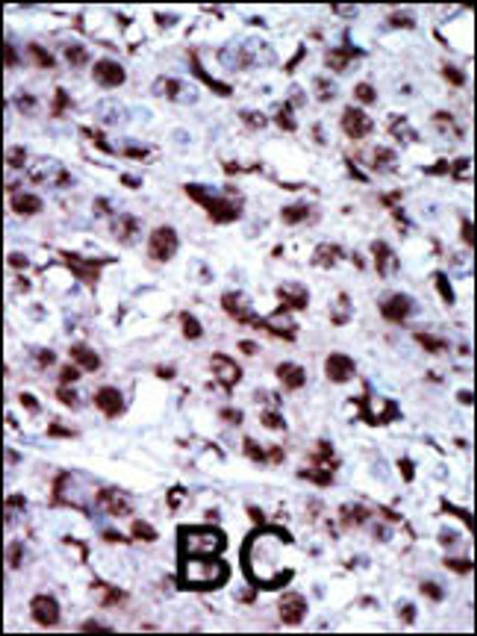 Formalin-fixed and paraffin-embedded human cancer tissue reacted with the primary antibody, which was peroxidase-conjugated to the secondary antibody, followed by AEC staining. BC = breast carcinoma; HC = hepatocarcinoma.