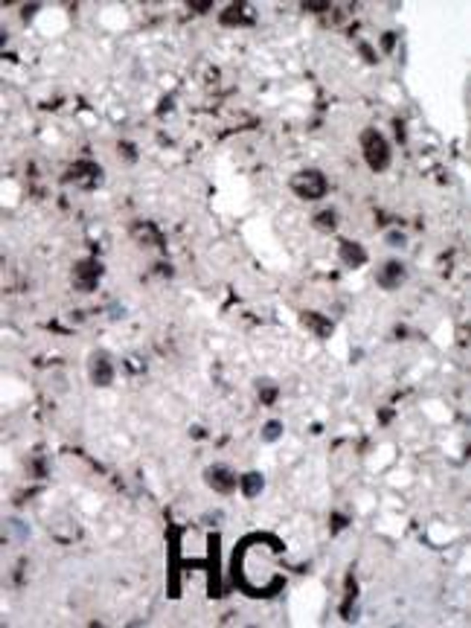 Formalin-fixed and paraffin-embedded human cancer tissue reacted with the primary antibody, which was peroxidase-conjugated to the secondary antibody, followed by DAB staining. BC = breast carcinoma; HC = hepatocarcinoma.