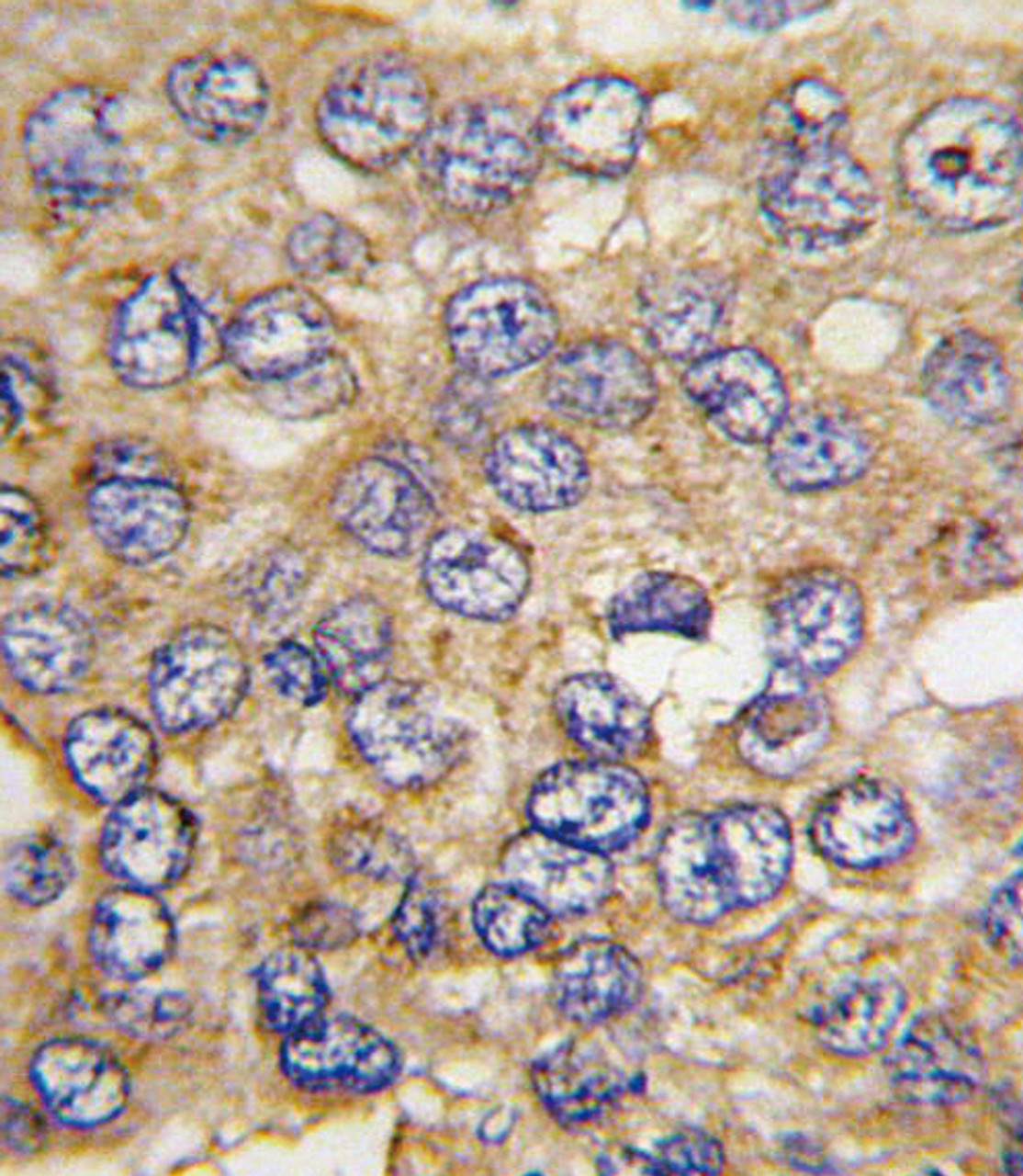 Formalin-fixed and paraffin-embedded human hepatocarcinoma tissue reacted with PFKFB4 antibody, which was peroxidase-conjugated to the secondary antibody, followed by DAB staining.