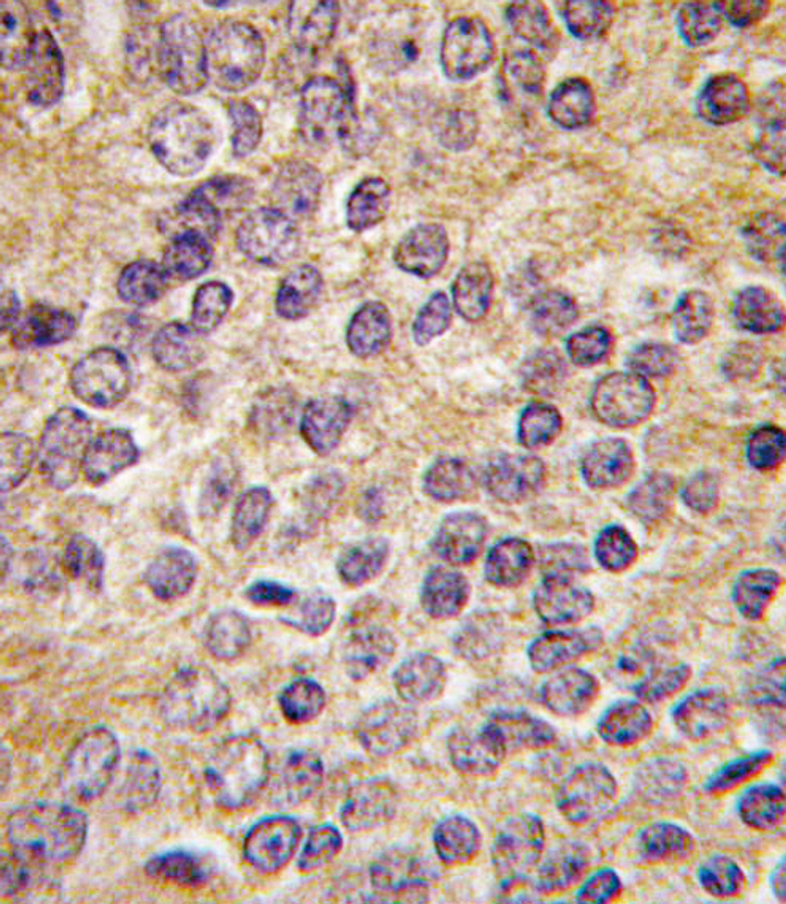 Formalin-fixed and paraffin-embedded human prostata carcinoma tissue reacted with PLAU antibody (C-term ) , which was peroxidase-conjugated to the secondary antibody, followed by DAB staining.