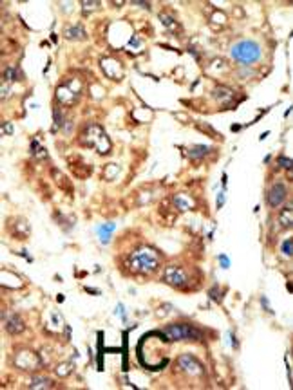 Formalin-fixed and paraffin-embedded human cancer tissue reacted with the primary antibody, which was peroxidase-conjugated to the secondary antibody, followed by AEC staining. BC = breast carcinoma; HC = hepatocarcinoma.