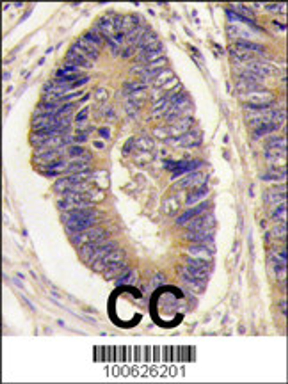 Formalin-fixed and paraffin-embedded human colon carcinoma tissue reacted with PTPH1 antibody, which was peroxidase-conjugated to the secondary antibody, followed by DAB staining.