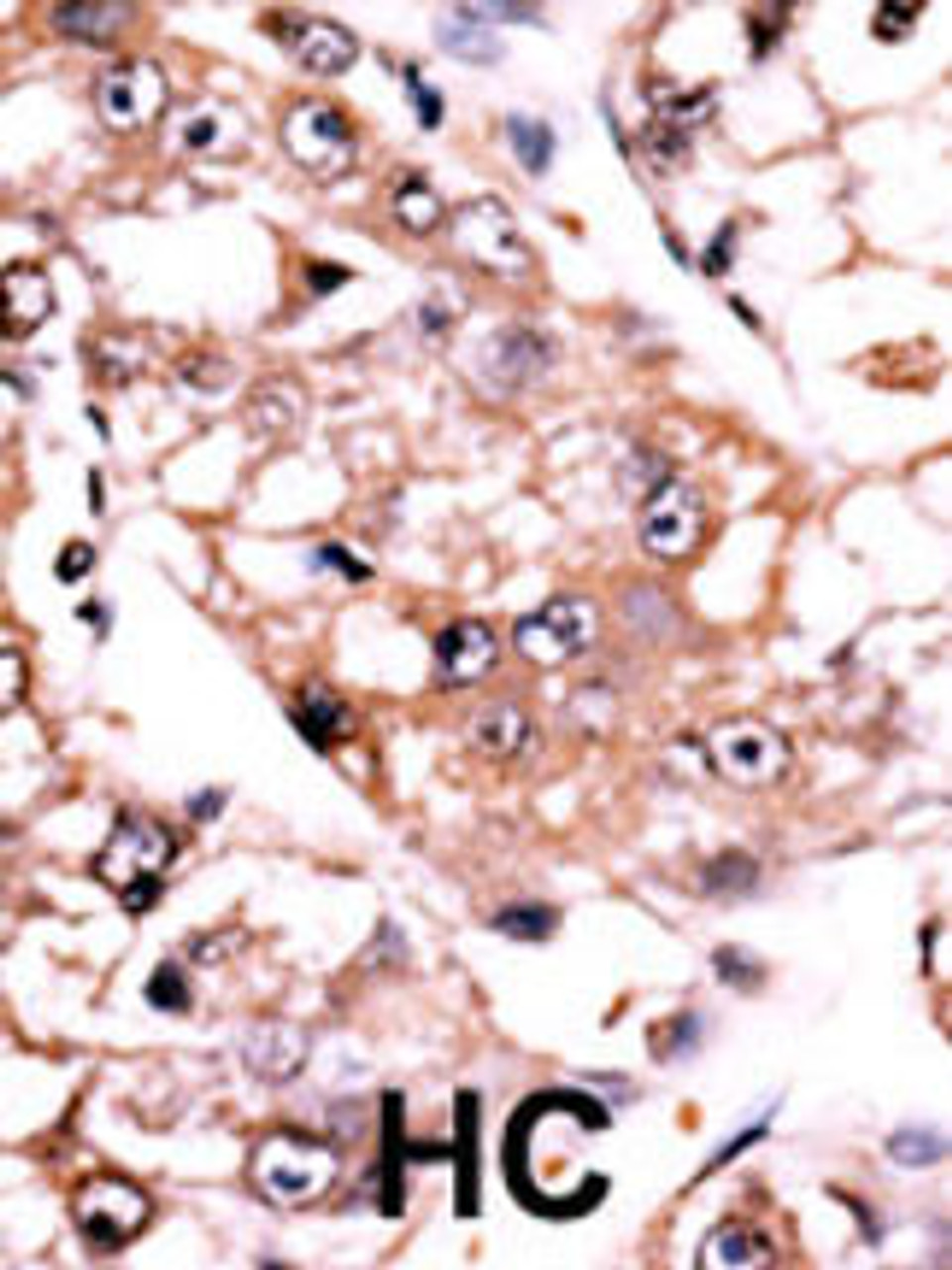 Formalin-fixed and paraffin-embedded human cancer tissue reacted with the primary antibody, which was peroxidase-conjugated to the secondary antibody, followed by AEC staining. BC = breast carcinoma; HC = hepatocarcinoma.