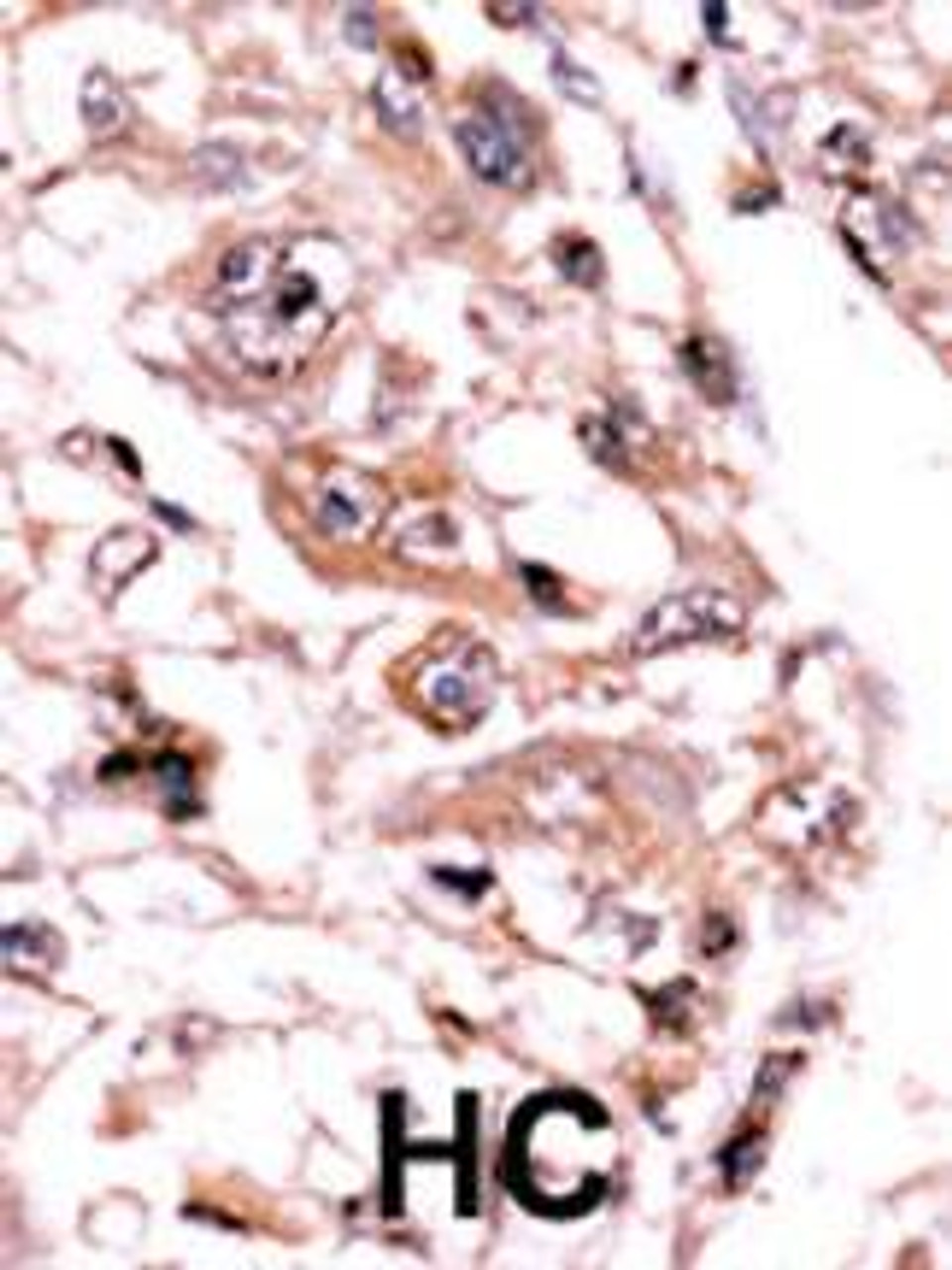 Formalin-fixed and paraffin-embedded human cancer tissue reacted with the primary antibody, which was peroxidase-conjugated to the secondary antibody, followed by AEC staining. BC = breast carcinoma; HC = hepatocarcinoma.