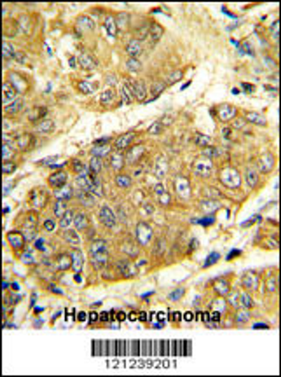 Formalin-fixed and paraffin-embedded human hepatocarcinoma reacted with LTA Antibody, which was peroxidase-conjugated to the secondary antibody, followed by DAB staining.
