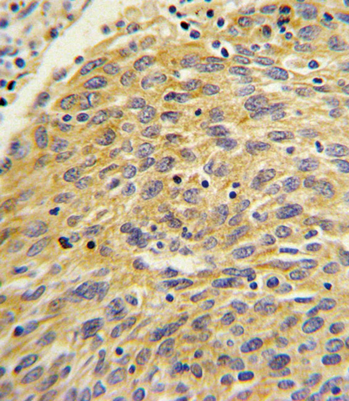 Formalin-fixed and paraffin-embedded human lung carcinoma with PLA2G4A Antibody, which was peroxidase-conjugated to the secondary antibody, followed by DAB staining.