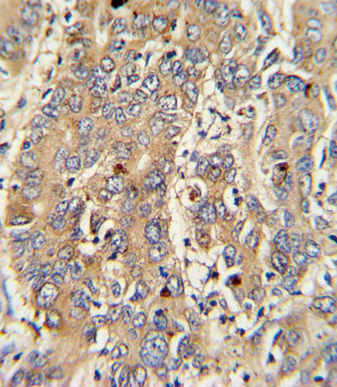 Formalin-fixed and paraffin-embedded human hepatocarcinoma with PIGR Antibody, which was peroxidase-conjugated to the secondary antibody, followed by DAB staining.