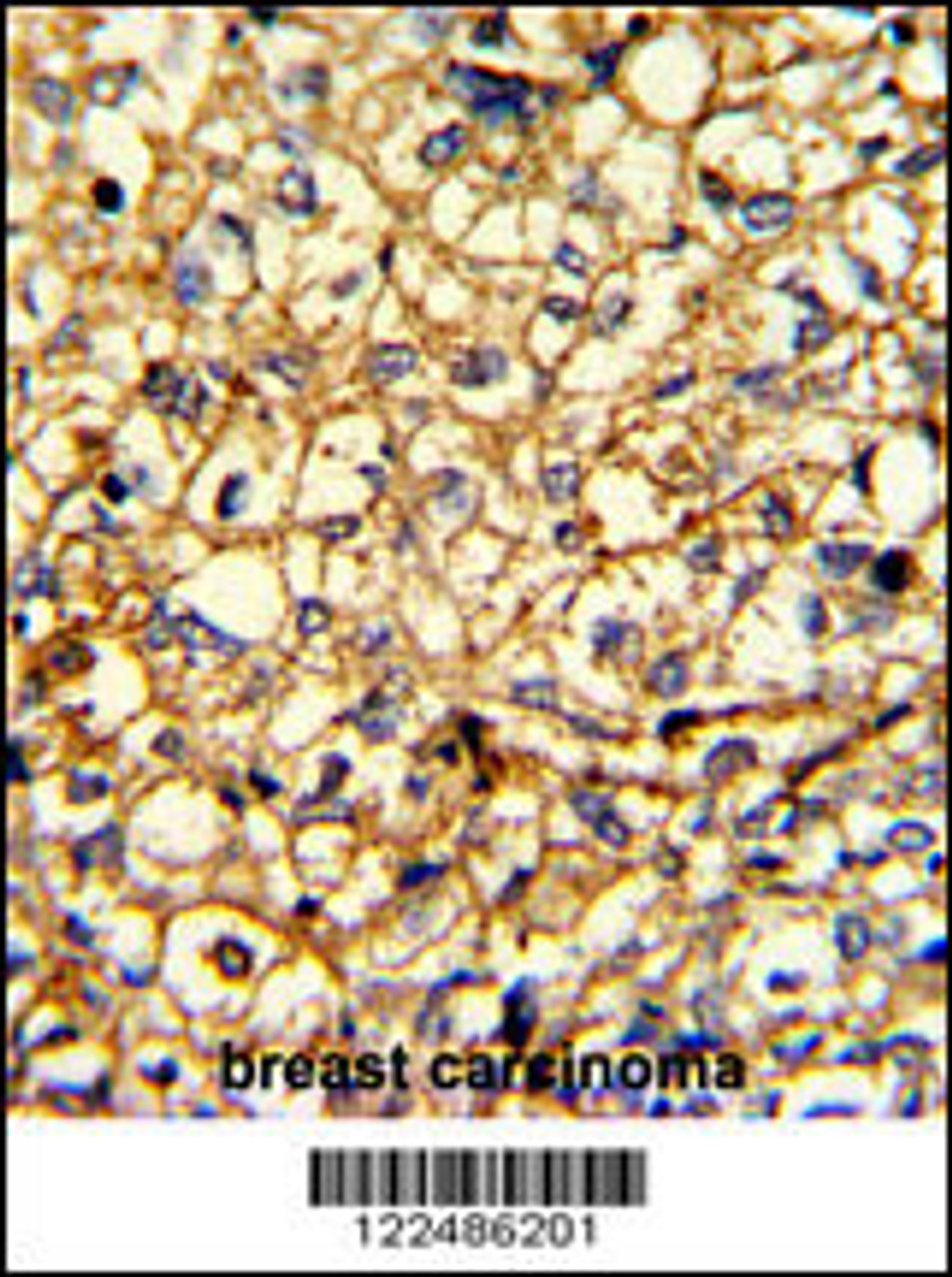 Formalin-fixed and paraffin-embedded human breast carcinoma with ADRA2B Antibody, which was peroxidase-conjugated to the secondary antibody, followed by DAB staining.