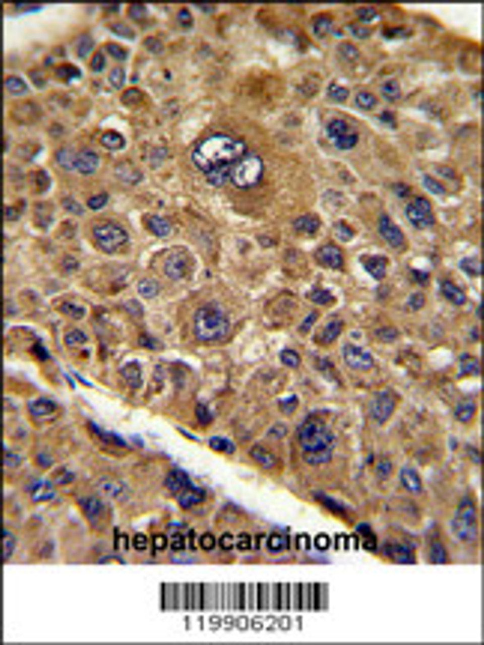 Formalin-fixed and paraffin-embedded human hepatocarcinoma reacted with TOB1 Antibody (N-term) , which was peroxidase-conjugated to the secondary antibody, followed by DAB staining.