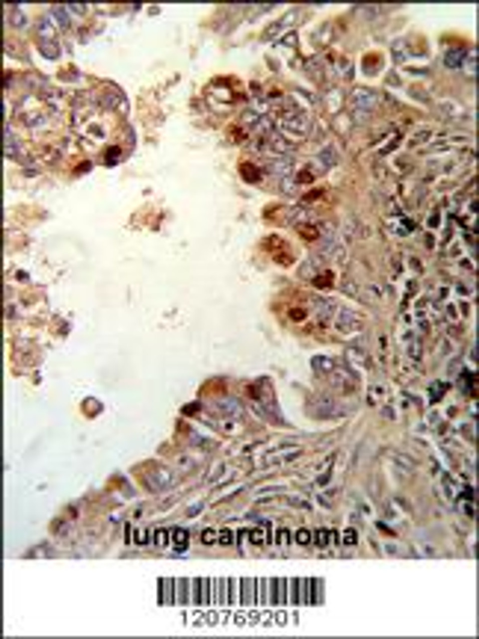 Formalin-fixed and paraffin-embedded human lung carcinoma reacted with PRKCA Antibody (N-term) , which was peroxidase-conjugated to the secondary antibody, followed by DAB staining.