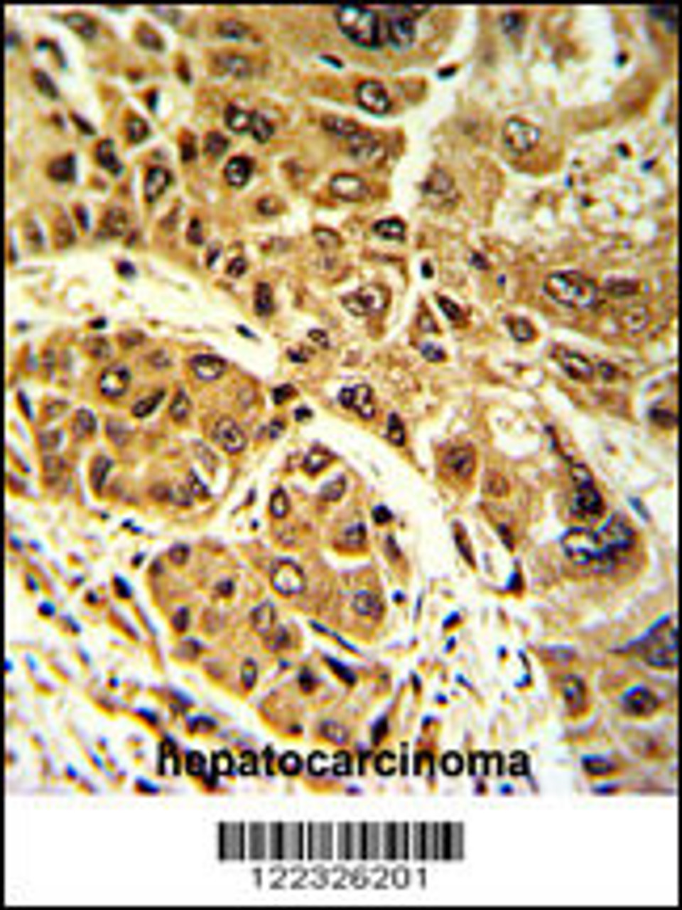 Formalin-fixed and paraffin-embedded human hepatocarcinoma with LPIN2 Antibody, which was peroxidase-conjugated to the secondary antibody, followed by DAB staining.