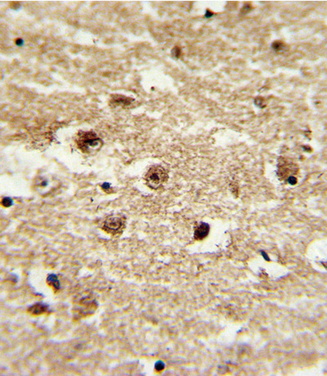 Formalin-fixed and paraffin-embedded human brain tissue with IGFBP2 Antibody, which was peroxidase-conjugated to the secondary antibody, followed by DAB staining.