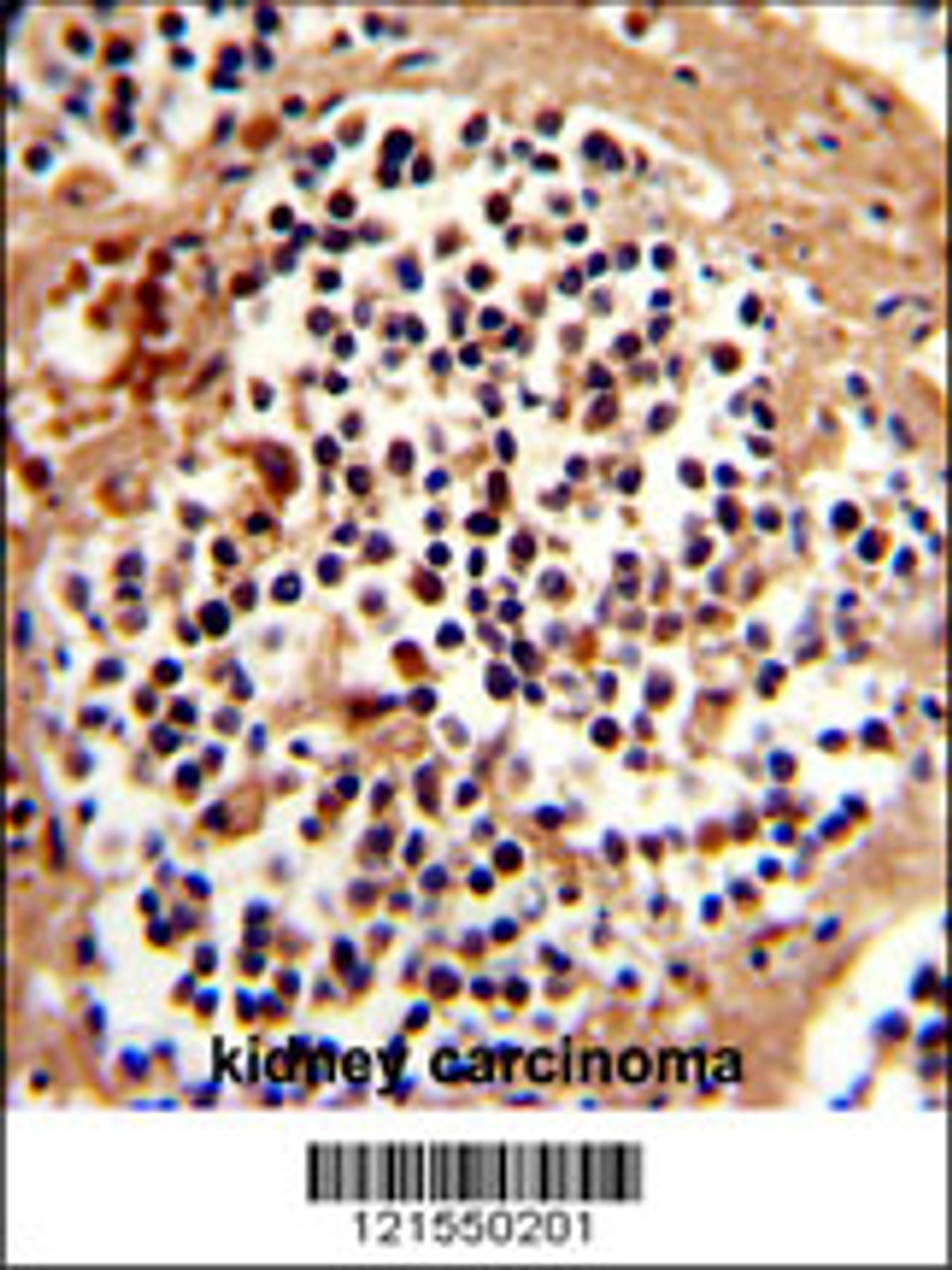 Formalin-fixed and paraffin-embedded human kidney carcinoma reacted with SERPINB7 Antibody, which was peroxidase-conjugated to the secondary antibody, followed by DAB staining.