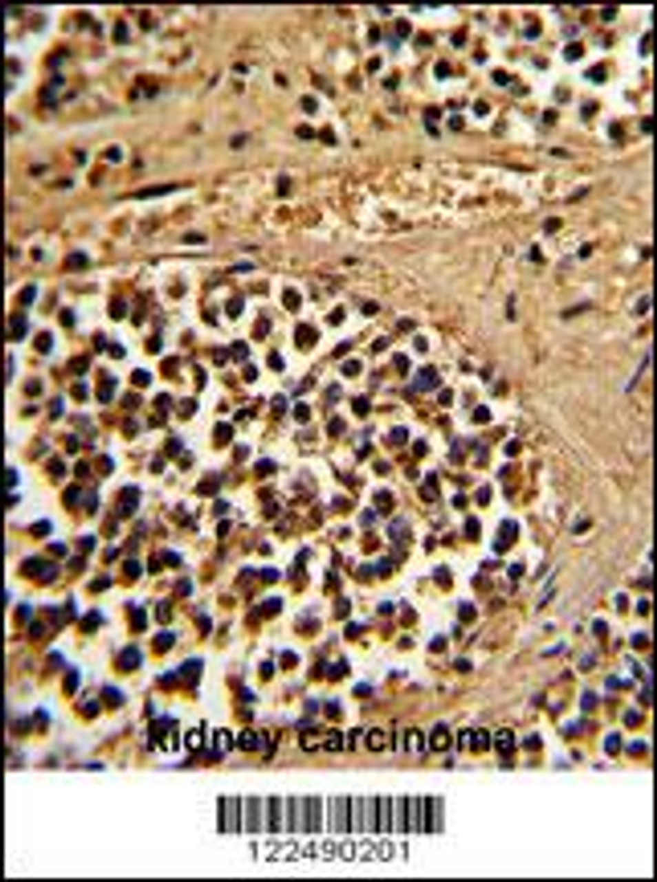 Formalin-fixed and paraffin-embedded human kidney carcinoma reacted with ESRRA Antibody, which was peroxidase-conjugated to the secondary antibody, followed by DAB staining.
