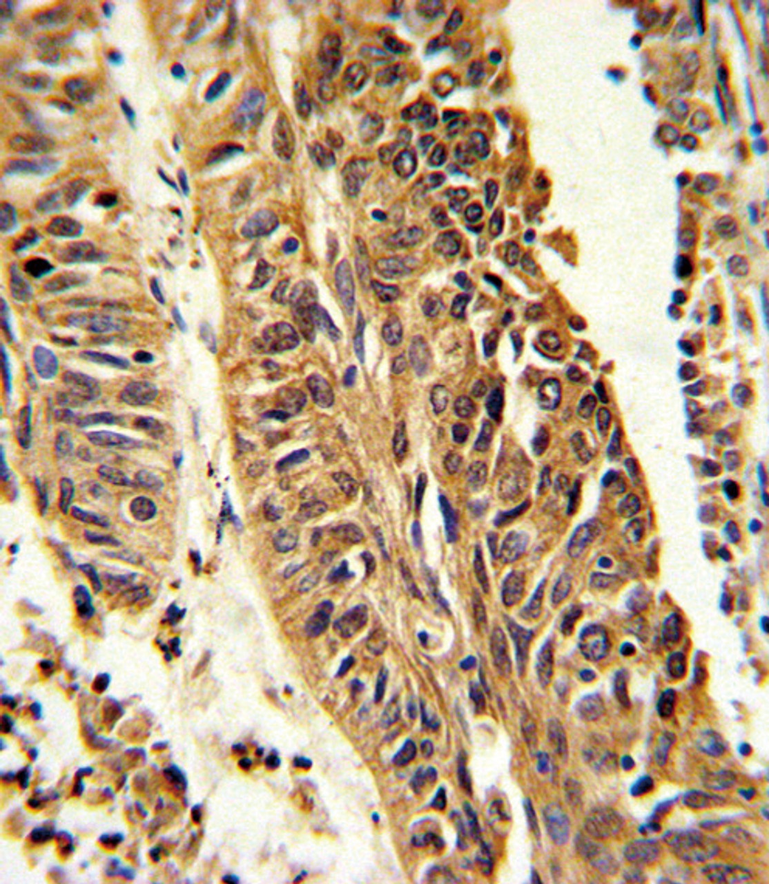 Formalin-fixed and paraffin-embedded human lung carcinoma reacted with CYP4B1 Antibody, which was peroxidase-conjugated to the secondary antibody, followed by DAB staining.