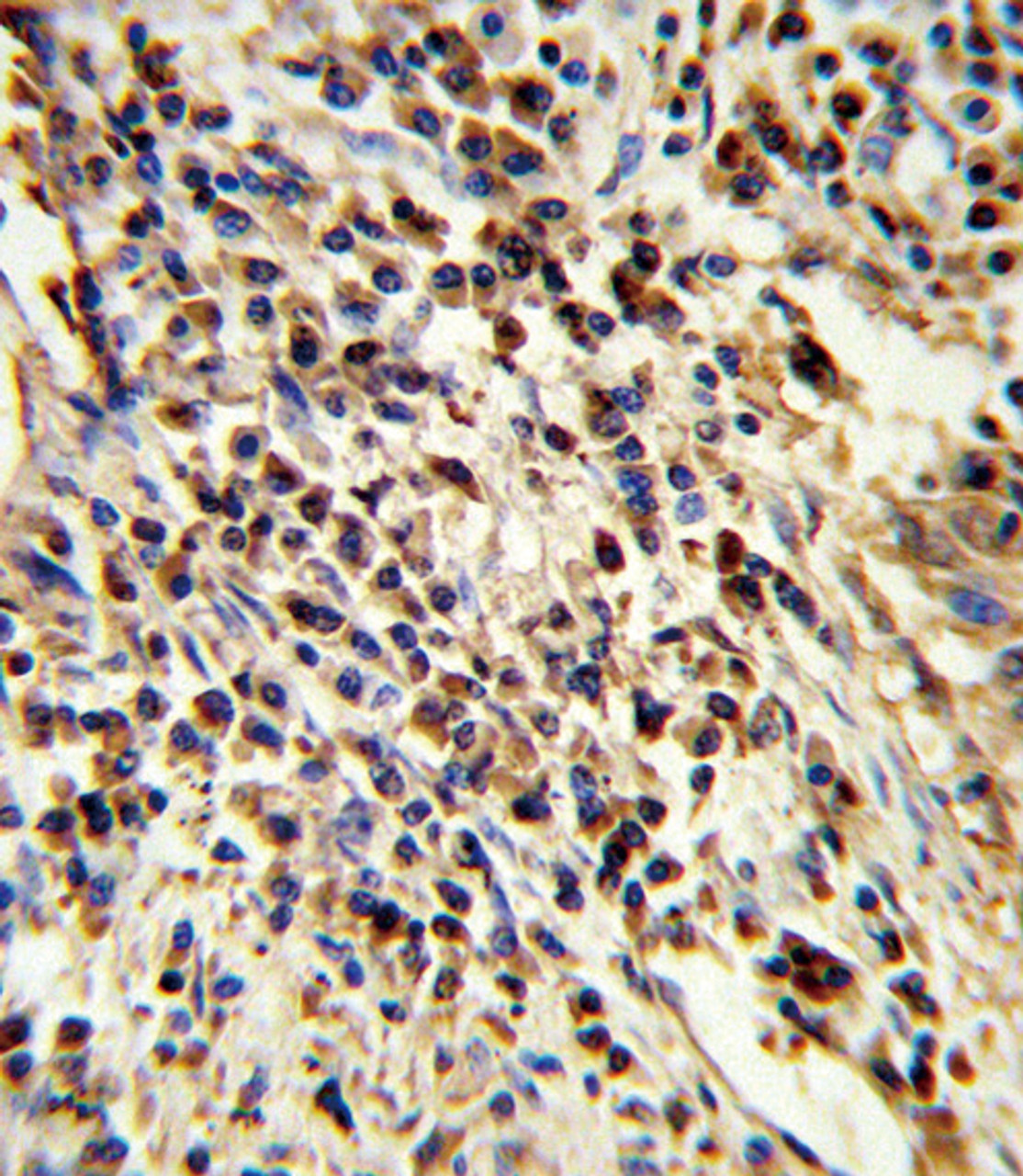 Formalin-fixed and paraffin-embedded human lung carcinoma reacted with PSMA7 Antibody, which was peroxidase-conjugated to the secondary antibody, followed by DAB staining.