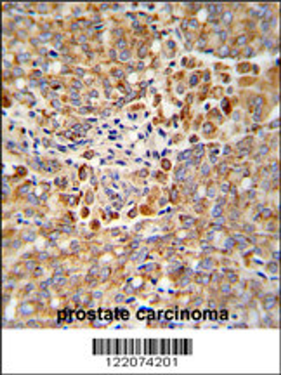 Formalin-fixed and paraffin-embedded human prostate carcinoma reacted with ALKBH3 Antibody, which was peroxidase-conjugated to the secondary antibody, followed by DAB staining.