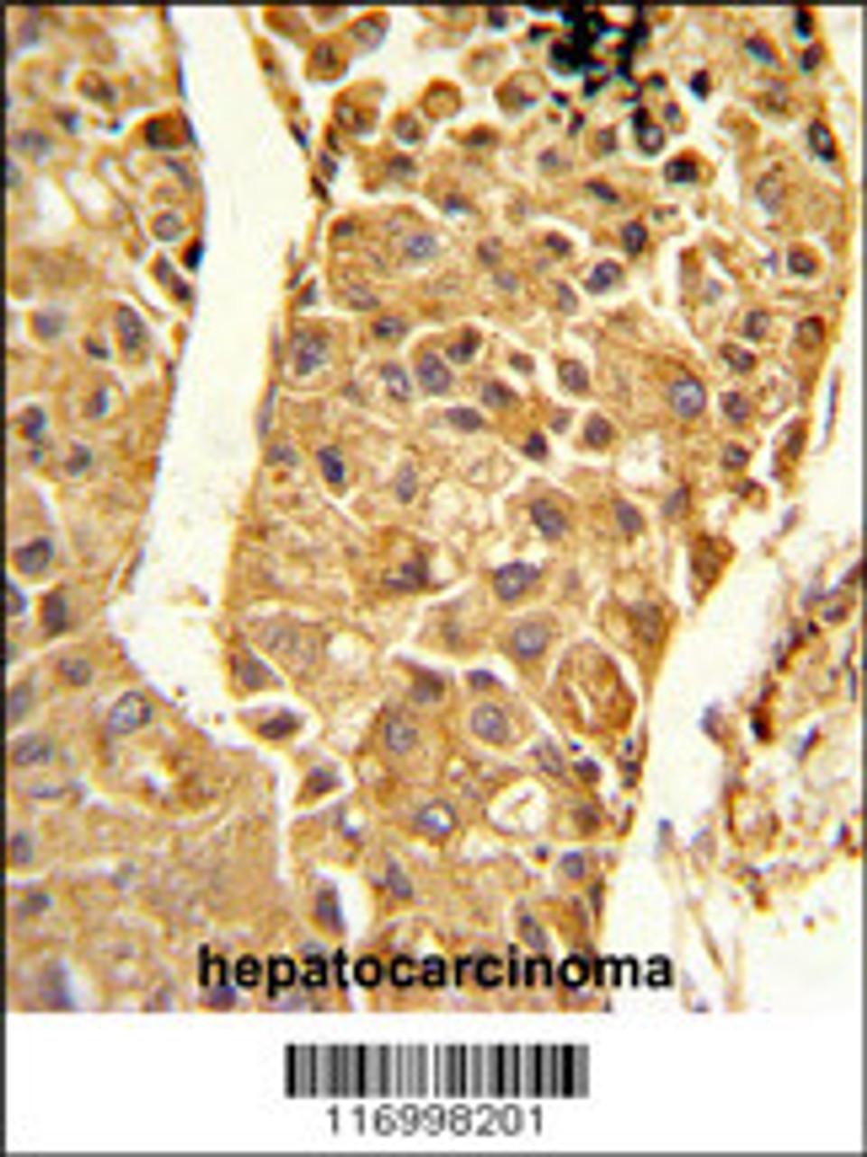 Formalin-fixed and paraffin-embedded human hepatocarcinoma reacted with CYP2C18 Antibody, which was peroxidase-conjugated to the secondary antibody, followed by DAB staining.