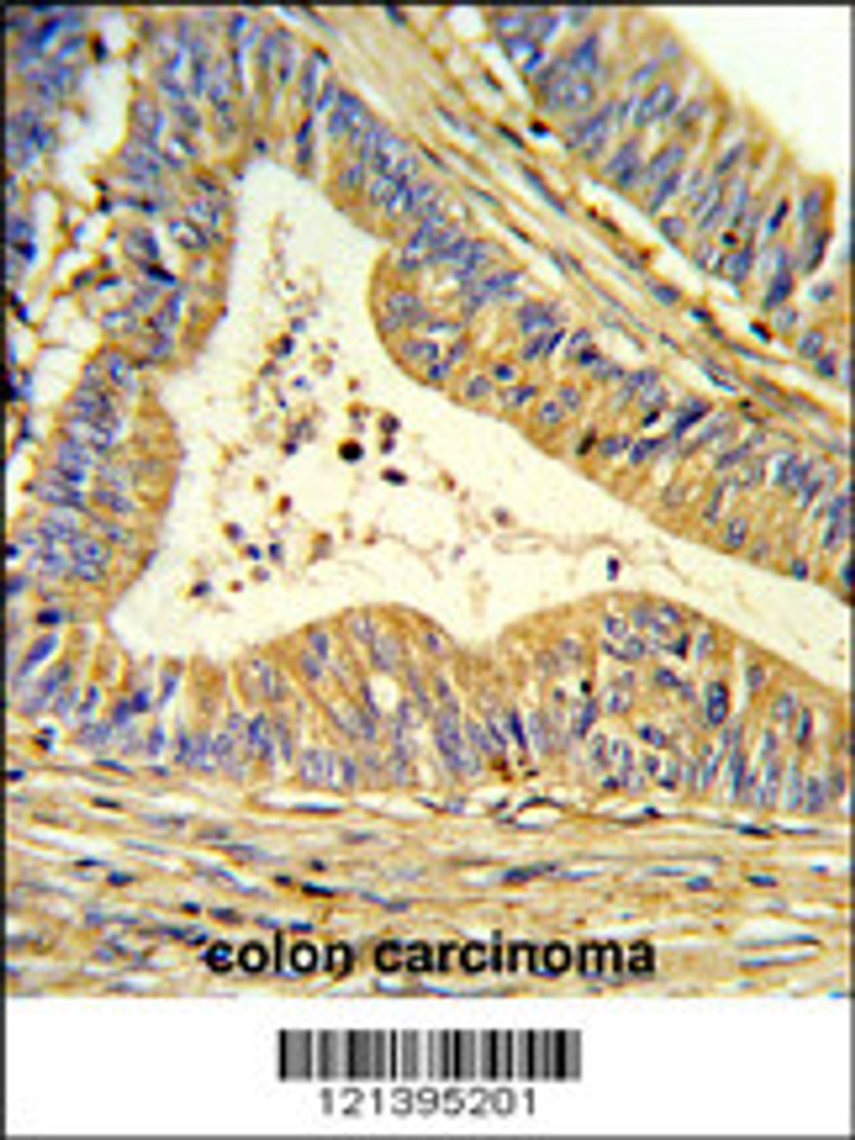 Formalin-fixed and paraffin-embedded human colon carcinoma reacted with SOD1 Antibody, which was peroxidase-conjugated to the secondary antibody, followed by DAB staining.