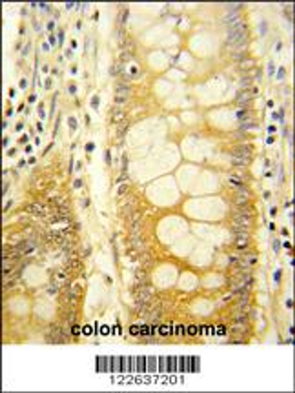 Formalin-fixed and paraffin-embedded human colon carcinoma reacted with LGALS2 Antibody, which was peroxidase-conjugated to the secondary antibody, followed by DAB staining.