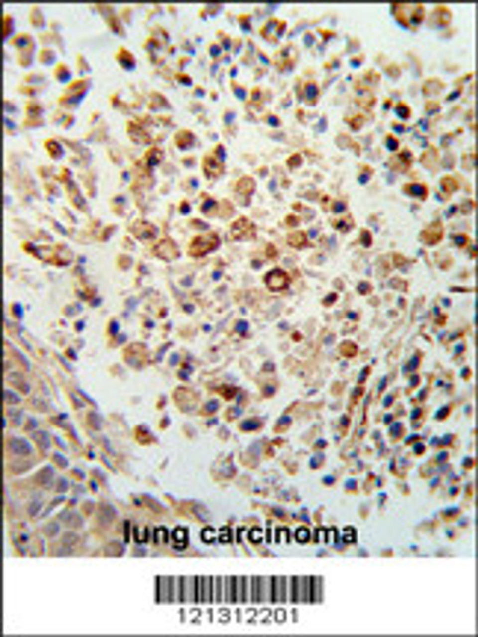 Formalin-fixed and paraffin-embedded human lung carcinoma reacted with FPRL2 Antibody, which was peroxidase-conjugated to the secondary antibody, followed by DAB staining.