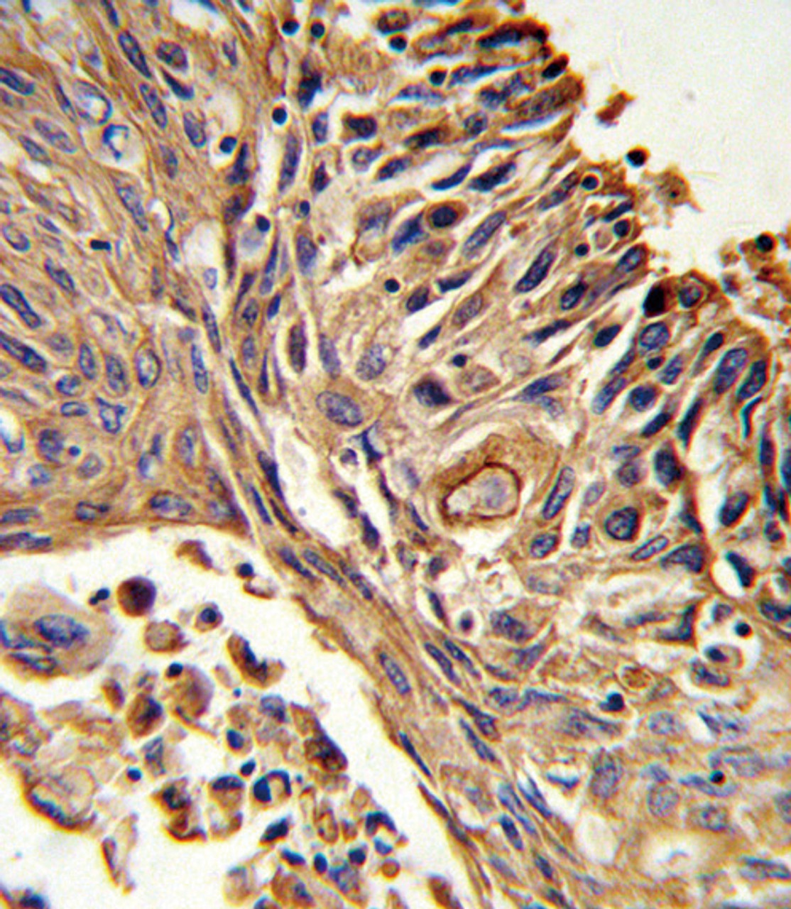 Formalin-fixed and paraffin-embedded human lung carcinoma reacted with IL18RAP Antibody (N-term) , which was peroxidase-conjugated to the secondary antibody, followed by DAB staining.