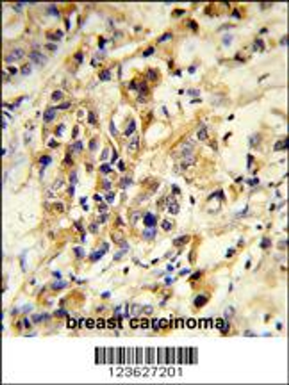 Formalin-fixed and paraffin-embedded human breast carcinoma reacted with RPGRIP1 Antibody, which was peroxidase-conjugated to the secondary antibody, followed by DAB staining.