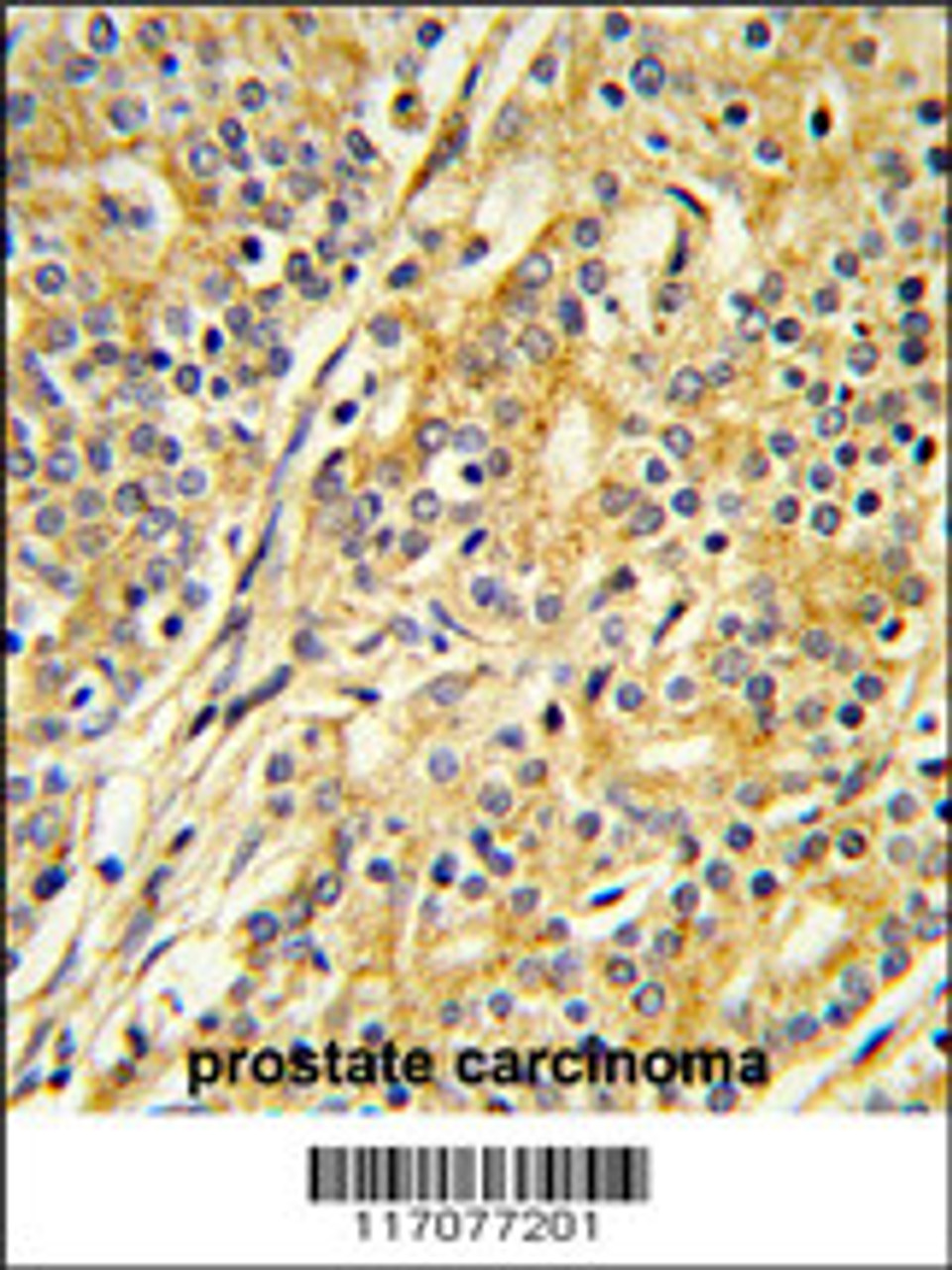 Formalin-fixed and paraffin-embedded human prostate carcinoma reacted with CYP51A1 Antibody, which was peroxidase-conjugated to the secondary antibody, followed by DAB staining.