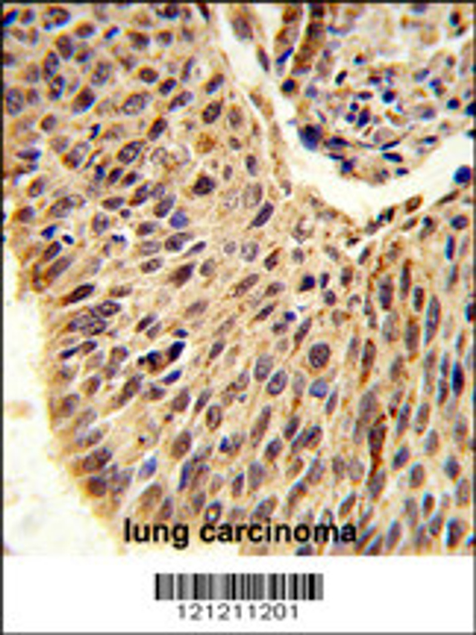 Formalin-fixed and paraffin-embedded human lung carcinoma reacted with GLIS1 Antibody (N-term) , which was peroxidase-conjugated to the secondary antibody, followed by DAB staining.