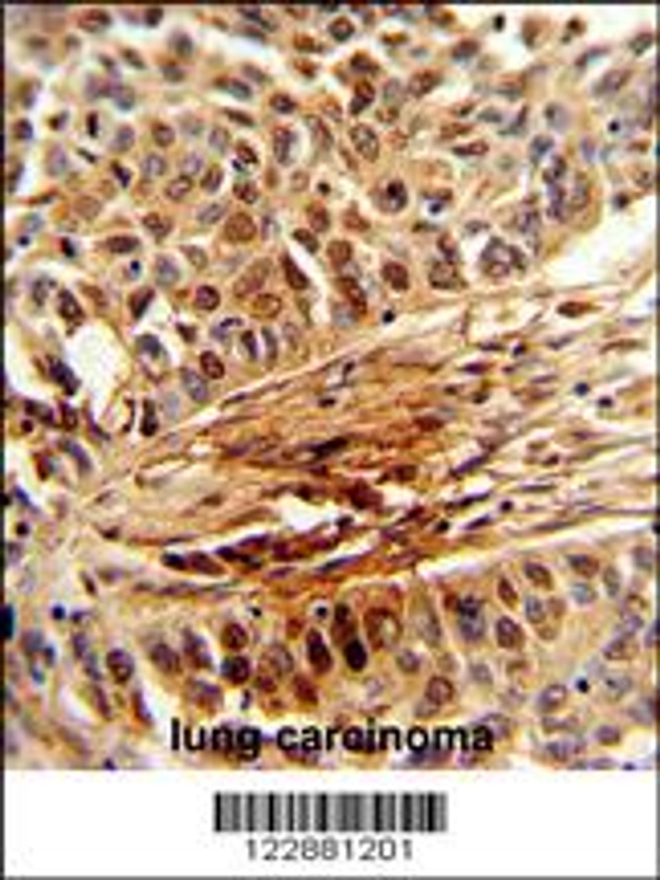 Formalin-fixed and paraffin-embedded human lung carcinoma reacted with PIN1 Antibody, which was peroxidase-conjugated to the secondary antibody, followed by DAB staining.