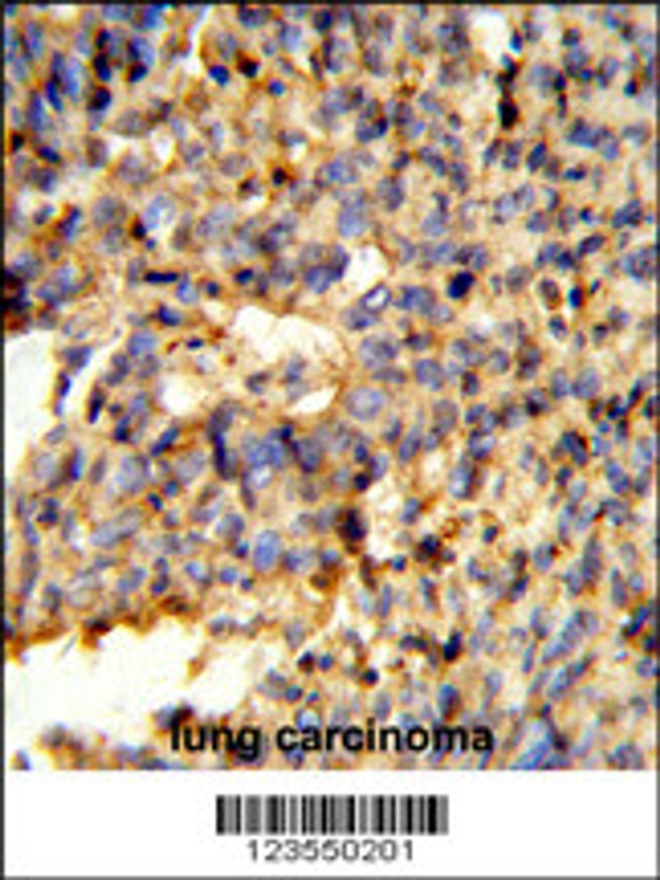 Formalin-fixed and paraffin-embedded human lung carcinoma reacted with FCGR2C Antibody, which was peroxidase-conjugated to the secondary antibody, followed by DAB staining.