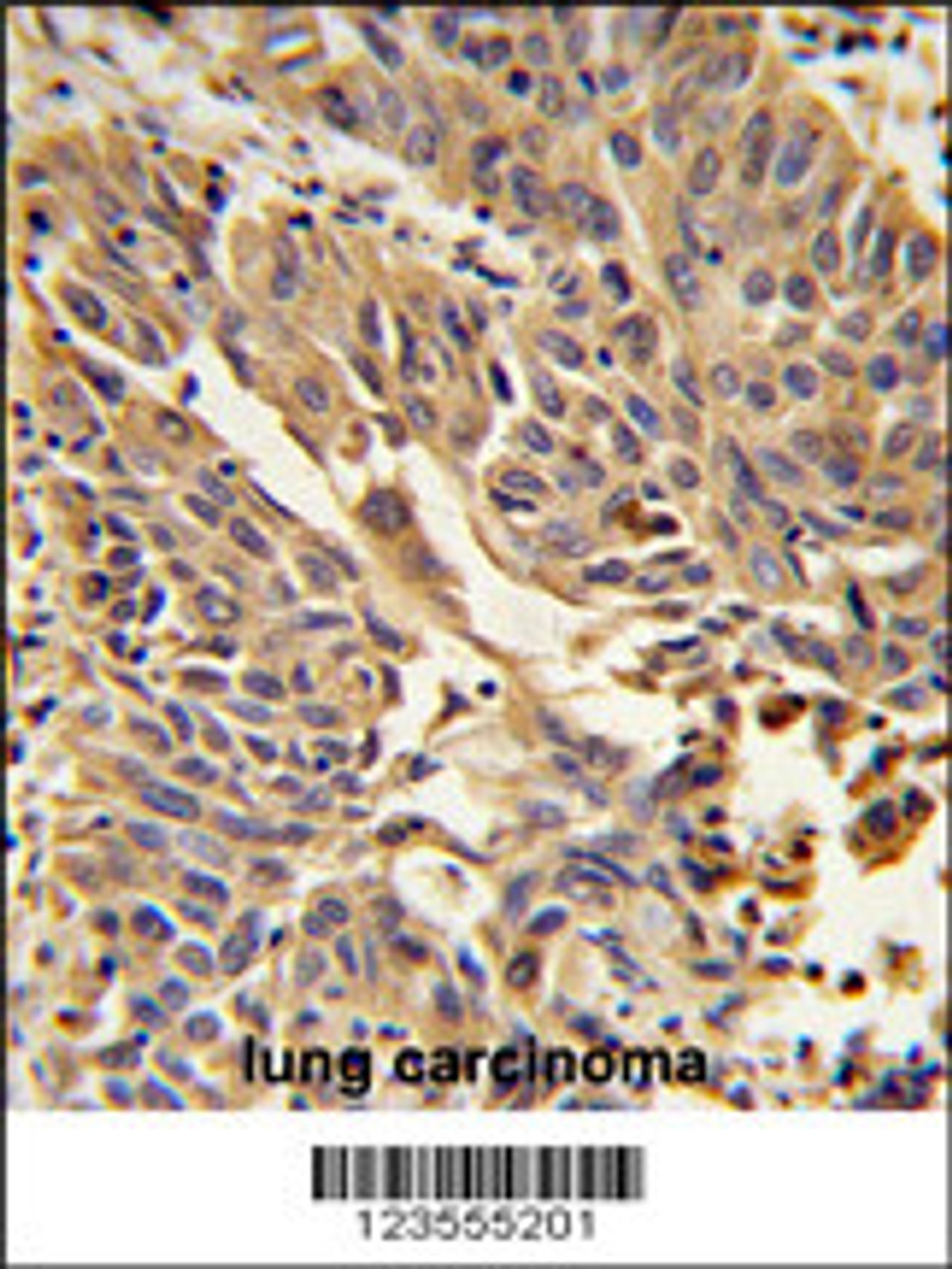 Formalin-fixed and paraffin-embedded human lung carcinoma reacted with JUP Antibody, which was peroxidase-conjugated to the secondary antibody, followed by DAB staining.