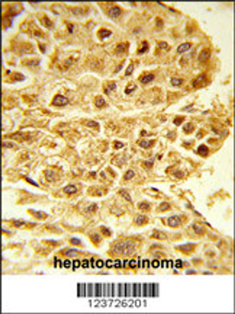 Formalin-fixed and paraffin-embedded human hepatocarcinoma reacted with E2F5 Antibody (N-term) , which was peroxidase-conjugated to the secondary antibody, followed by DAB staining.
