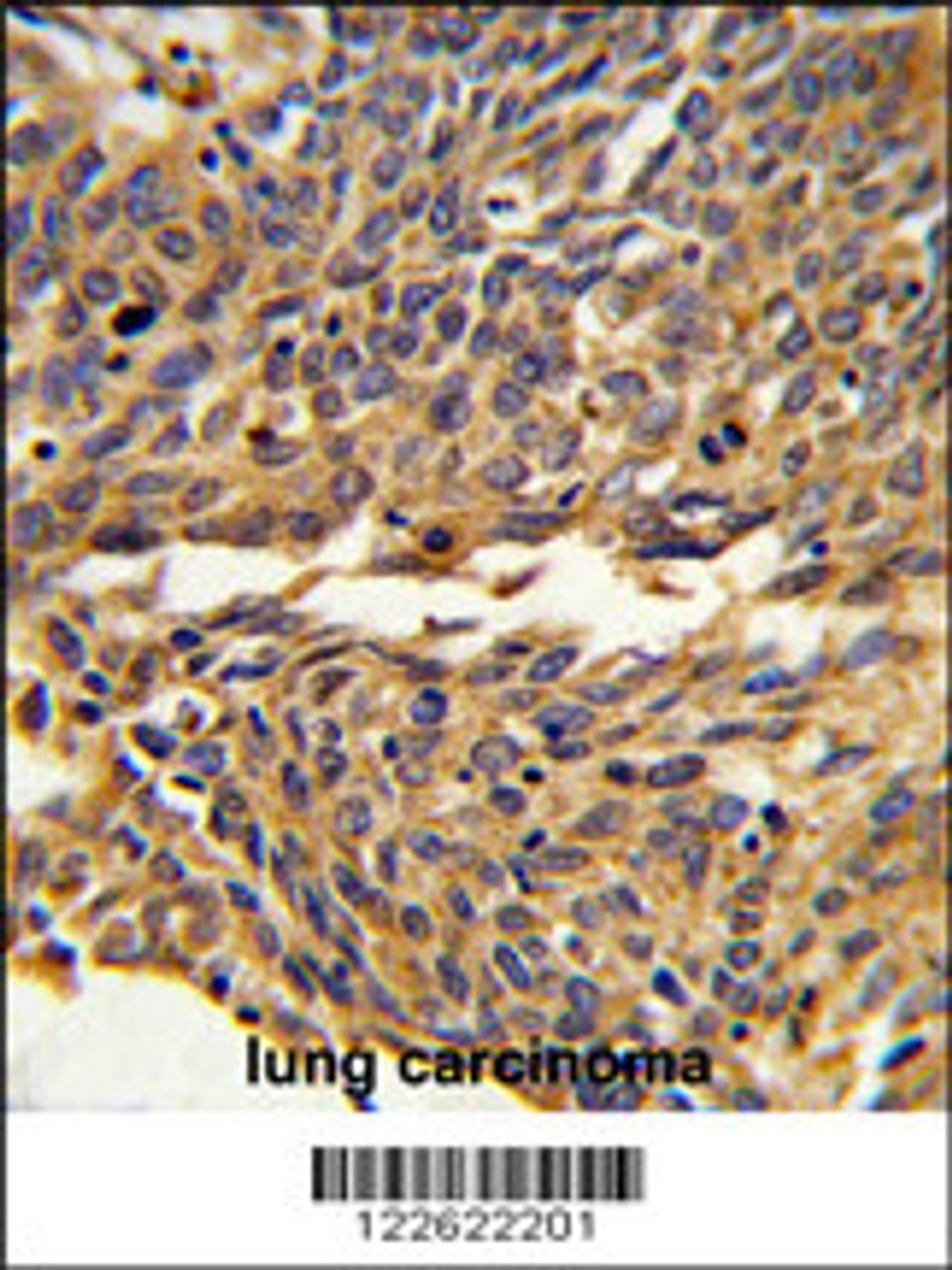 Formalin-fixed and paraffin-embedded human lung carcinoma reacted with EXOC5 Antibody, which was peroxidase-conjugated to the secondary antibody, followed by DAB staining.